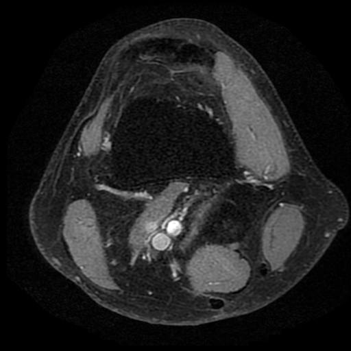 Figure 2 for case Third head of the gastrocnemius